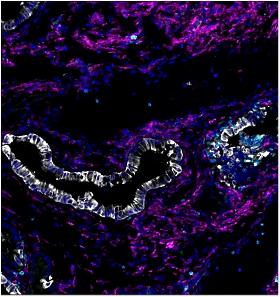 Pancreatic Cancer, induced by activation of the PIK3CA oncogene