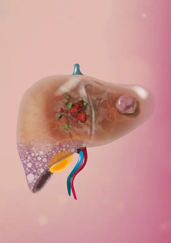 Inflammatory fatty liver disease and liver cancer - an artistic illustration