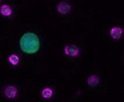 Zirkulierende Tumorzelle (CTC) aus Diagnostischer Leukapherese. Leukozytenmarker (CD45) in violett, Panzytokeratin in grün als Marker für CTCs, Kernfärbung in blau (DAPI)