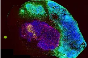 IPTO (individualized patient tumor organoid) © Haikun Liu, Ph.D.