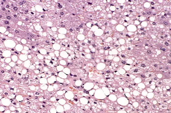 Histological section of a murine liver showing severe steatosis.