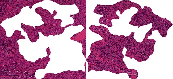 A section through breast cancer tissue: When immune cells (small dark cells) invade the tumor, breast cancer patients have good chances that chemotherapy treatment is effective. The right image shows predominantly tumor cells (round purple cells). In the left image immune cells are infiltrating the tumor.