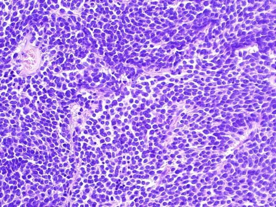 Diagnose „neuroektodermaler Tumor des Zentralnervensystems“: Die Tumorzellen sind meist undifferenziert und weisen kaum charakteristische Merkmale auf.