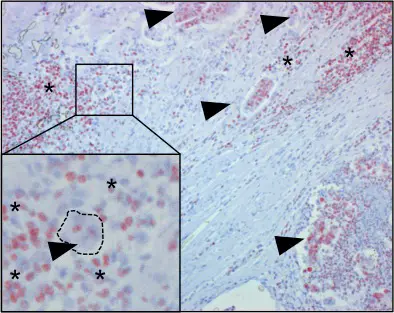 HMGB1 positive (rote Färbung) Immunzellen infiltrieren einen Dickdarmtumor.