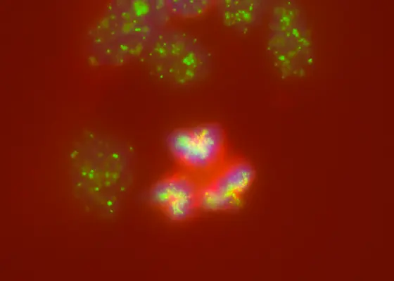 In neuroblastomas, cell division gets out of hand: instead of dividing chromosomes (blue) evenly among daughter cells, several spindle poles (green) and spindle apparatuses (red) form, even leading to the breakage of chromosomes or their incorrect division.