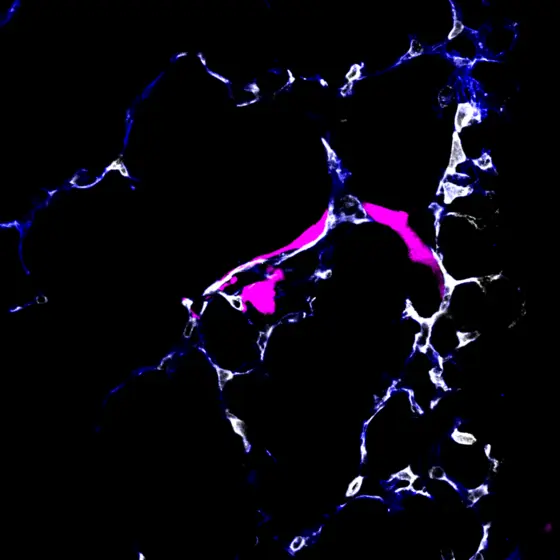 Partially extravasated metastasizing tumor cells (pink) exiting from the pulmonary circulation (white).