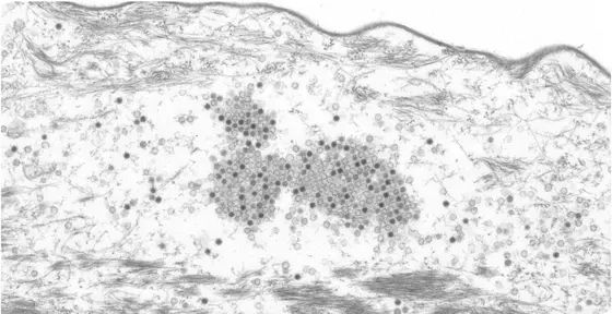 Papillomaviruses in the stratum corneum of a skin tumor of a Mastomys coucha