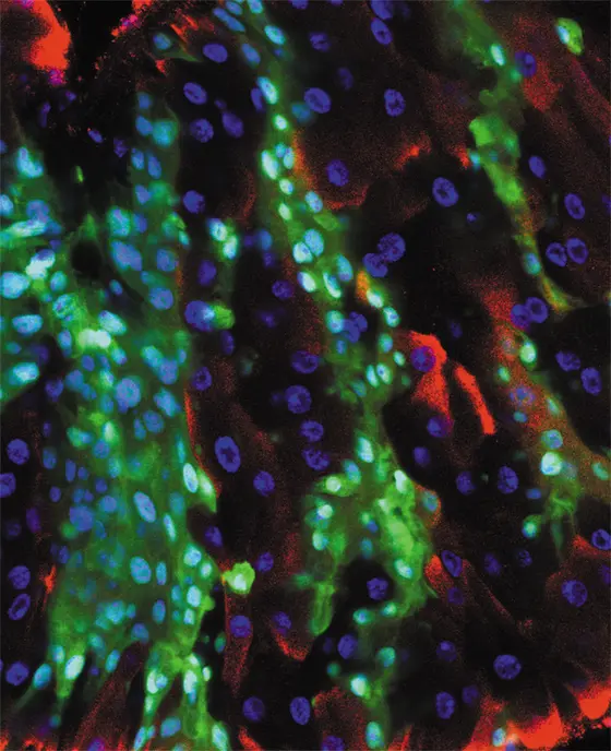 Darmkrebszellen (grün) im Darmgewebe von Drosophila. Sterbende Zellen sind rot markiert.