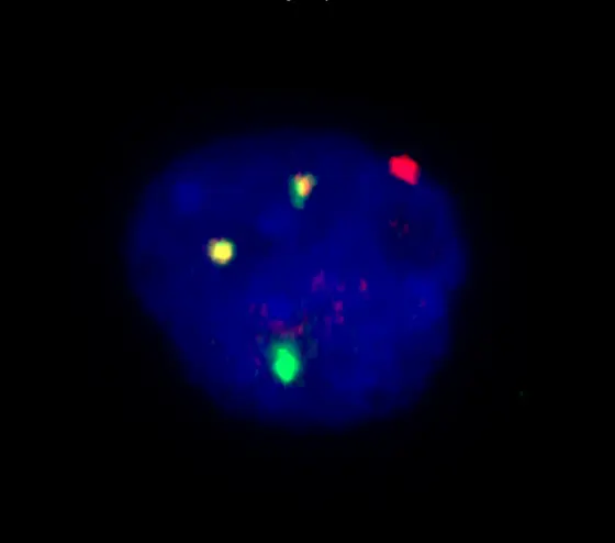 Leukämiezelle mit dem Chromosomenfehler 8;21: Die beiden gelben Signale zeigen, wo sich jeweils ein Stück eines Chromosoms 8 (rot) mit einem Stück von Chromosom 21 (grün) verbunden hat.“