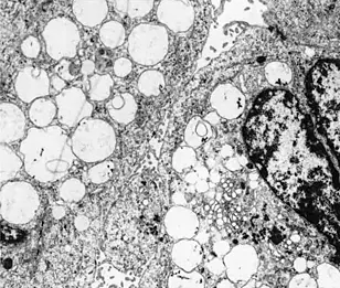 Elektronenmikroskopische Aufnahme von sterbenden Hirntumorzellen: Riesenmitochondrien erscheinen als weiße runde Strukturen - Wilfried Roth, Deutsches Krebsforschungszentrum