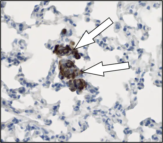 Early lung metastasis in a mouse: arrows indicate metastatic breast cancer cells (brown) colonizing the lung (blue). Cell nuclei are stained dark blue.