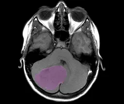 MRT-Image of a Medulloblastoma