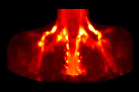 Kälte bringt das braune Fettgewebe zum Leuchten (Positronen-Emissionstomographie)