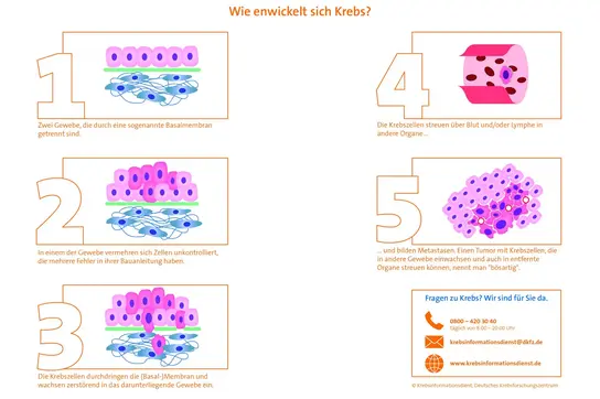 Grafische Darstellung in Form von fünf Bildern, die zeigen wie Krebs entsteht. Bild 1 zeigt zwei Gewebe, die durch eine Basalmembran getrennt sind. Bild 2 zeigt wie sich Zellen in einem Gewebe unkontrolliert vermehren. Bild 3 zeigt wie Krebszellen die Basalmembran durchdringen und in das gesunde Gewebe einwachsen. Bild 4 zeigt wie Krebszellen über die Blutbahn streuen. Bild 5 zeigt wie Krebszellen Metastasen bilden.