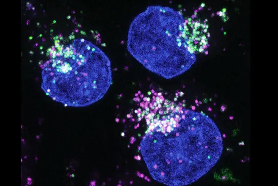 Human cancer cells (cell nucleus in blue) feeding on protein (Albumin, labelled in green). The proteins are digested and broken down into amino acids in the lysosomes (magenta).