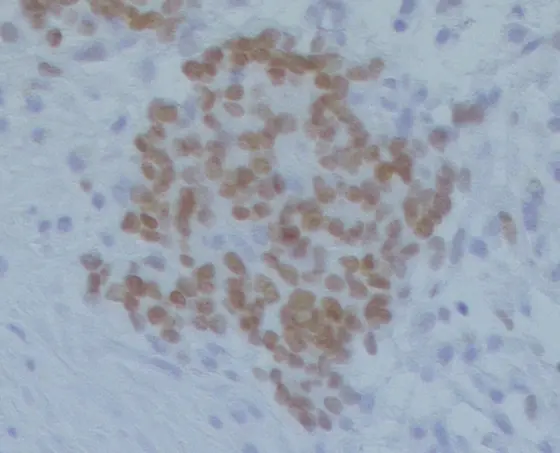 Stained neuroblastoma cells of a liver metastasis.