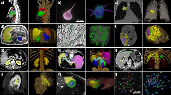 nnU-Net handles a broad variety of datasets and target image properties. All examples originate from the test sets of different international segmentation challenges that nnU-Netwas applied on. Target structures for each dataset are shown in 2D projected onto the raw data (left) and in 3D together with a volume rendering of the raw data (right). All visualizations are created with the MITK Workbench.