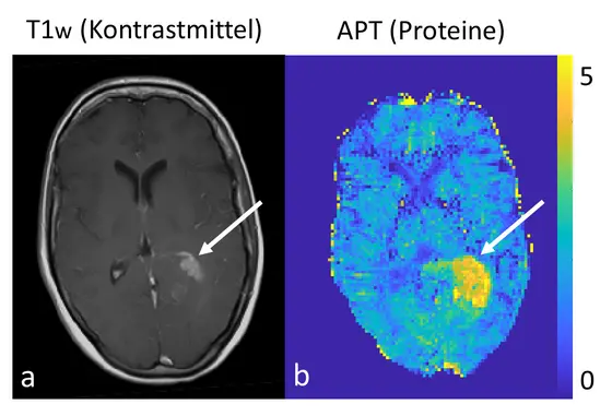 Links die konventionelle morphologische kontrastmittelverstärkte Darstellung eines Hirntumors mit einem klinischen 3-Tesla MRT, rechts die kontrastmittelfreie Protein-Messung mit dem 7-Tesla MRT.