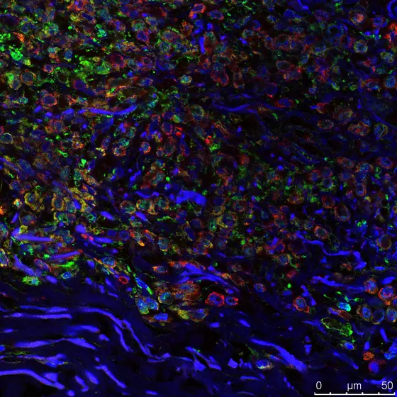 „Tumor in situ“ – die Melanomzellen haben ihr Ursprungsgewebe, die Epidermis, noch nicht verlassen (grün: Bindegewebszellen, rot: ausgeschiedene Pigmentkörperchen der Melanomzellen, blau: DNA in den Zellkernen).